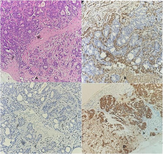 A breast biopsy core demonstrated dual cell proliferation (Ax10), confirming the presence of a basal layer with cytoplasmic staining for SMA (B) and nuclear P63 staining (C), alongside a luminal layer that stained positive for cytokeratin AE1/AE3 (D).