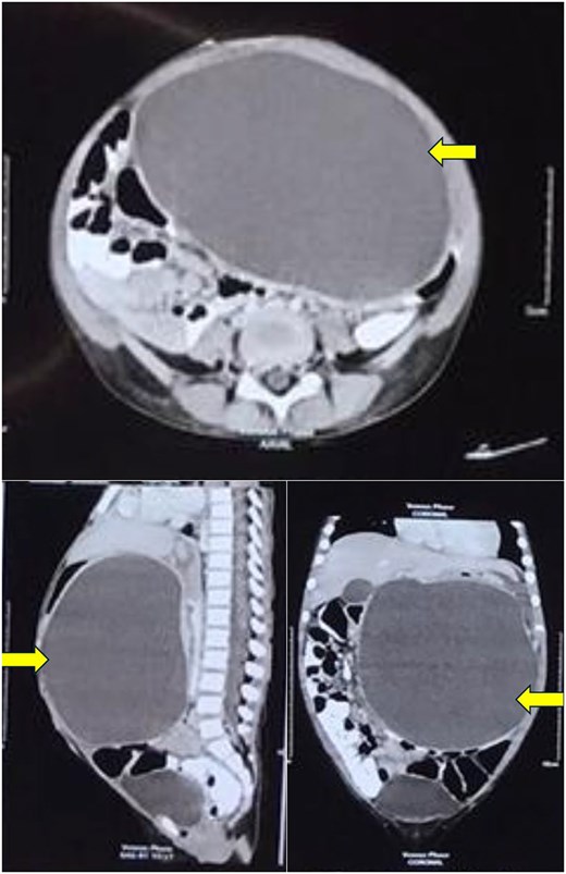 Computerized tomography of the abdomen showing a large thin-walled cystic hypodense lesion (arrow), anterior to the pancreas and compressing it, anteriorly displacing the stomach and compressing it, and abutting the anterior abdominal wall in axial, sagittal, and coronal views.