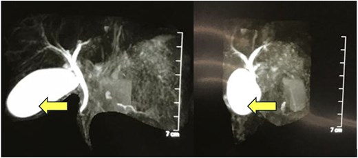 MRCP showing a thick-walled cystic lesion (arrow), anterior to the pancreas, postero-inferior to the stomach, extending up to the anterior abdominal wall, with an inner mucosal lining suggestive of a gastric duplication cyst.