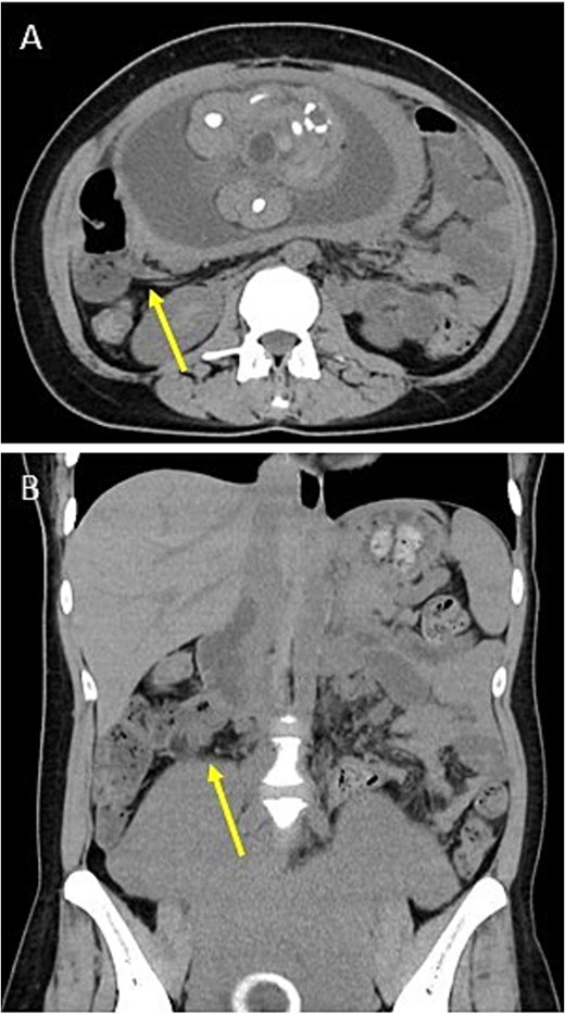 Preoperative images. Plain CT shows no appendix in the axial plane (A) or the coronal plane (B). Arrows indicate the terminal ileum.