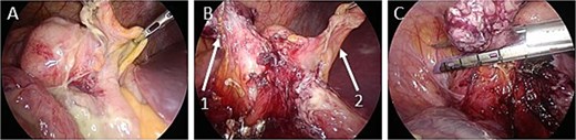 Intraoperative images. (A) There is contaminated ascites around the ileocecal area. (B) The appendiceal mesentery and appendiceal artery are dissected (arrow 1: appendix; arrow 2: ileocecal fold). (C) The appendix is dissected with an automatic suture device.