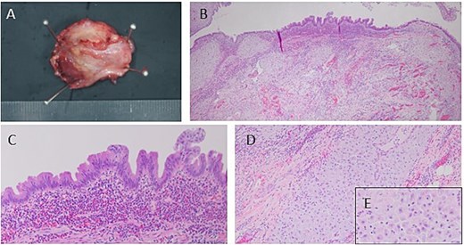 Image of the resected specimen. (A) The resected appendix has a thickened appendix wall and a narrowed appendix lumen. (B–E) Microscopically, there is neutrophilic infiltration on the mucosal side of the appendix and decidual membrane in the stroma.