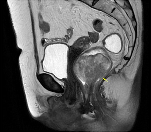 MRI of Case 1 shows a well-defined rectal tumor without regional lymph node involvement. The lesion demonstrates high signal intensity on sagittal T2-weighted imaging (indicated by the arrow).