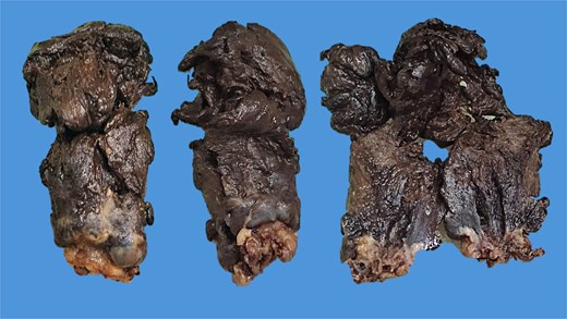 Macroscopic image of the surgical specimen from Case 1 depicting a blackish, pedunculated, polypoid lesion. The opened specimen shows anal mucosa at its base.