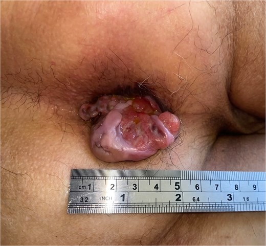 Clinical image of Case 2 showing a pink tumor in the anal region with superficial ulceration.