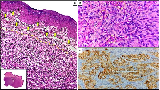 Histopathological findings of Case 2. (a) ARM exhibiting radial (solid arrows) and vertical (dotted lines) growth patterns; lower inset shows a panoramic view (H&E staining, 100×). (b) Malignant melanocytes with cytologic atypia and epithelioid morphology, displaying minimal melanin pigment (dotted circles; H&E staining, 400×). (c) Positive Melan-a expression in neoplastic cells (immunohistochemical staining, 100×).