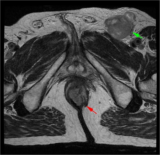 MRI of Case 2 shows an infiltrating anal tumor involving the internal and external sphincters, as well as perianal adipose tissue (lower arrow), with associated inguinal lymphadenopathy (upper arrow). The tumor demonstrates high signal intensity on axial T2-weighted imaging.