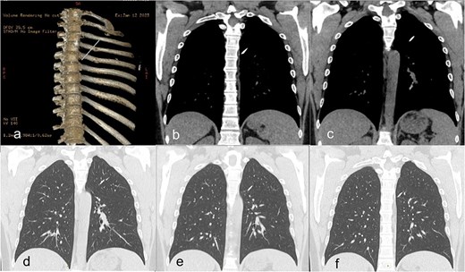 (a) Preoperative CT scan with 3D-reconstruction of skeletal structures and Kirschner wire. (b–f) Distal pin in the left lung transfixing the left upper lobe and fissure into the left lower lobe without pneumothorax.