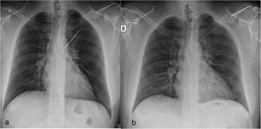 (a) Preoperative chest radiograph with 6.2 cm long K-wire in the left hemithorax. The lateral half of the pin (6.4 cm), located in the distal part of the left clavicle. (b) Postoperative chest radiograph with complete lung expansion after chest tube removal.