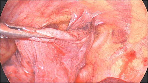 Perioperative views of the migrated K-wire, showing dense apical adhesions of the left upper lobe.