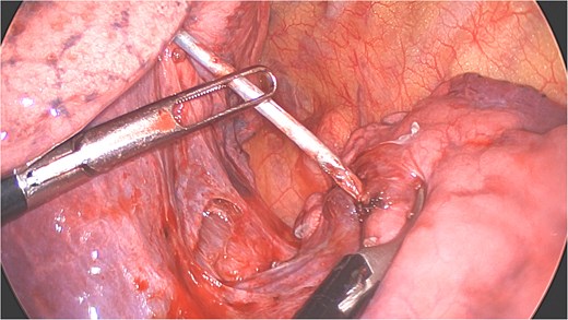 Distal part of K-wire stuck in segment 2 and the proximal part in the apical segment 6.