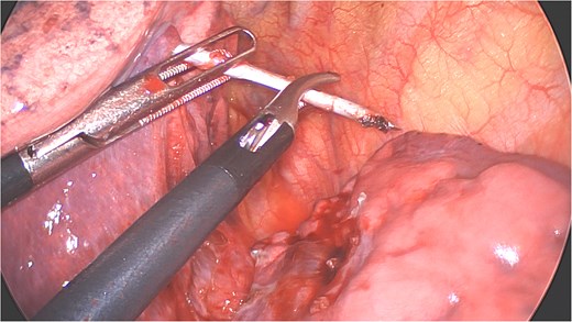 Extraction of the K-wire by pushing the parenchyma towards both extremities.