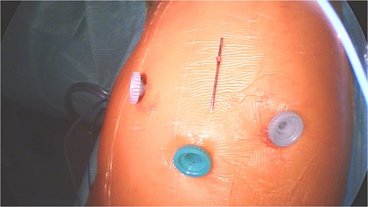 Overview of extracted K-wire and thoracoscopic ports.