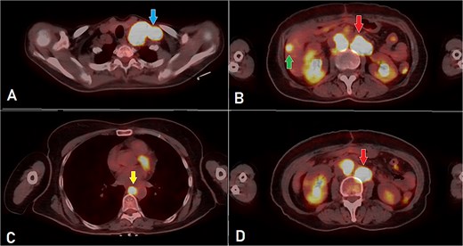 PET-CT scan (A) showing matted intensely hyper-metabolic left supraclavicular lymph nodes (arrow); (B) demonstrating intensely hyper-metabolic retroperitoneal lymph nodes (inferiorly pointing arrow) and a hyper-metabolic solitary hepatic lesion (superiorly pointing arrow); (C) demonstrating an intensely hyper metabolic mediastinal (para- oesophageal – station VIII) lymph node (arrow); and (D) revealing a few intensely hyper-metabolic retroperitoneal lymph nodes (arrow).