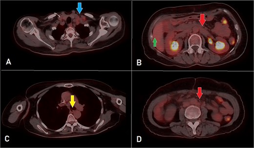 PET-CT scan at the corresponding cuts to Fig. 1 showing great metabolic and morphological regression regarding the previously seen (A) supraclavicular lymph nodes (arrow); (B) retroperitoneal lymph nodes (inferiorly pointing arrow) and hepatic lesion (superiorly pointing arrow); (C) mediastinal (para-oesophageal – station VIII) lymph node (arrow); and (D) retroperitoneal lymph nodes (arrow).