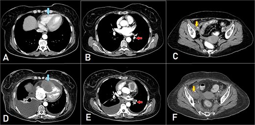 A, B, and C displaying the baseline images. (D) A mass lesion originating from the right ventricle (arrow). (E) Filling defect in the segmental branches of the pulmonary artery representing pulmonary embolism (arrow). (F) A newly seen right para-iliac lymph node (arrow).