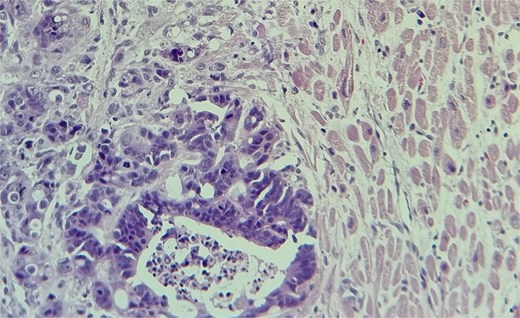 The metastatic tumor cells form glandular structures and infiltrate the myocardial tissue in a disorganized manner.