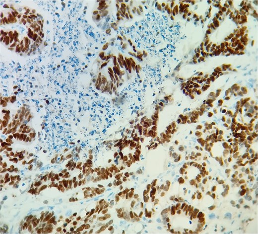 SATB2 immunostain supports the colonic origin of the tumor.