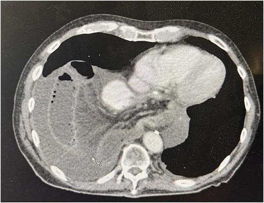 Preoperative CT image showing recurrent hiatal hernia with dilated small bowel in the right hemithorax, mesenteric edema, and surrounding fluid.