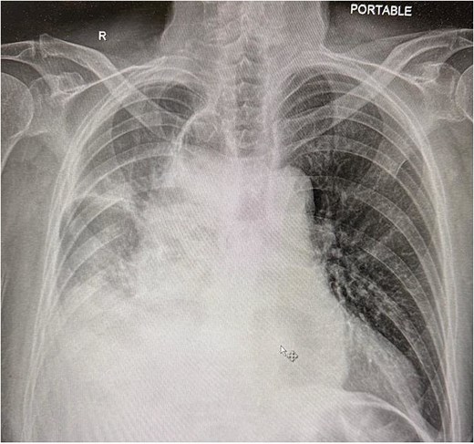 Chest X-ray showing compressed lung and fluid due to herniated small bowel.