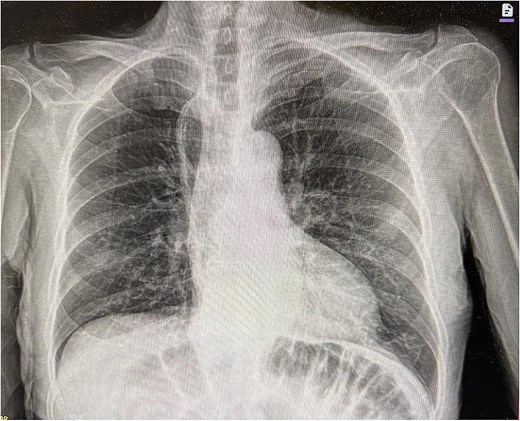 Postoperative chest X-ray imaging.
