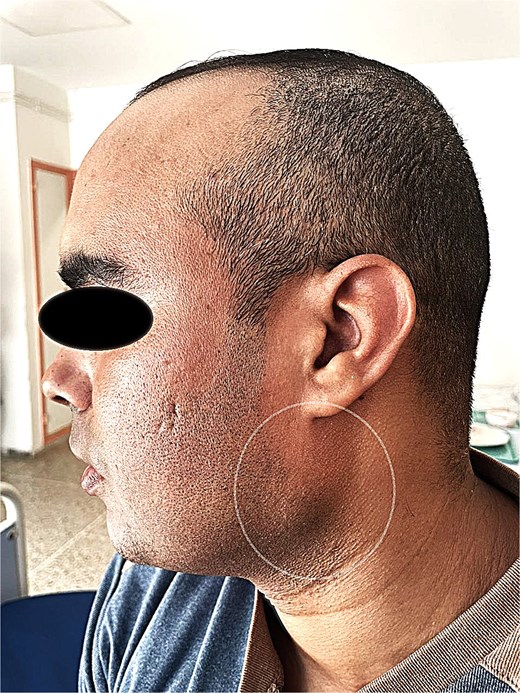 Preoperative photograph showing the sublobular swelling on the left side of the patient's face.