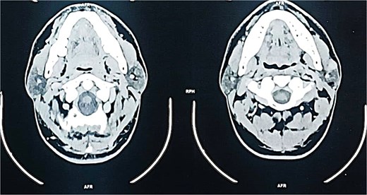 Axial contrast-enhanced CT scan demonstrating a well-defined, enhancing mass in the superficial lobe of the left parotid gland.