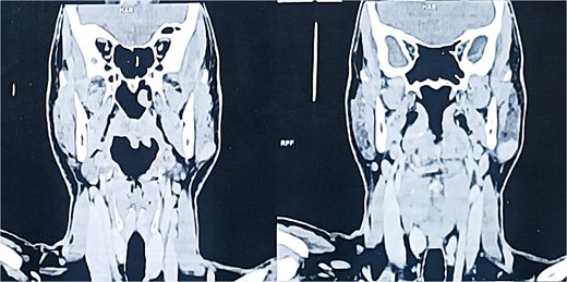 Coronal contrast-enhanced CT scan confirming the presence of an oval, homogeneous, enhancing lesion in the left parotid gland.