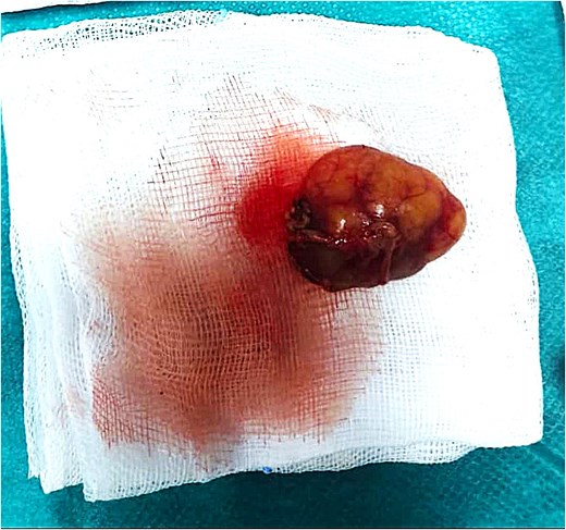 Macroscopic view of the excised tumor following superficial parotidectomy.
