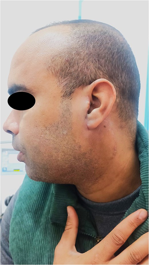 Postoperative photograph 6 months after surgery showing excellent healing and no signs of recurrence.