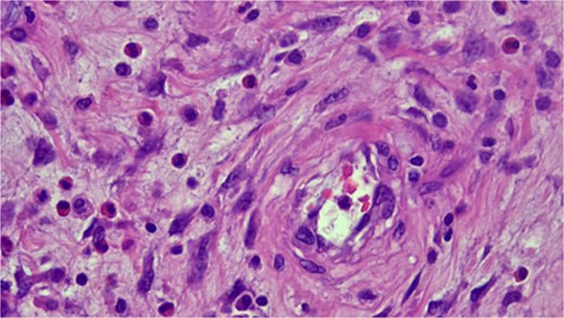 Histopathologic examination showing spindle cells in a fibromyxoid stroma with a mixed inflammatory reaction, consistent with an IFP (Vanek’s tumor).