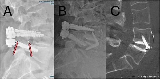 (A) Initial presentation with TLIF cage migration posteriorly into the spinal canal and paraspinal muscles. (B) Stage 1 and 2 completion, including revision fusion using an ALIF cage (Redmond Ti/PEEK, A-spine, Taiwan) and TLIF cage removal. (C) CT scan post TLIF removal and disc height restoration with ALIF cage.