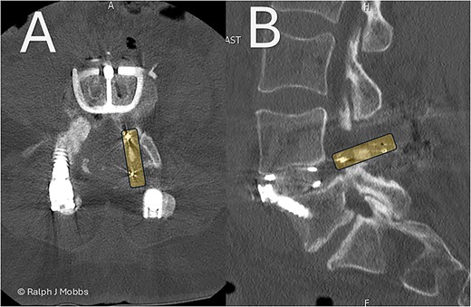 Day 1 postop ALIF. The PEEK cage can be seen in the canal and paraspinal regions. (A) Axial sequence. (B) Parasagittal sequence.
