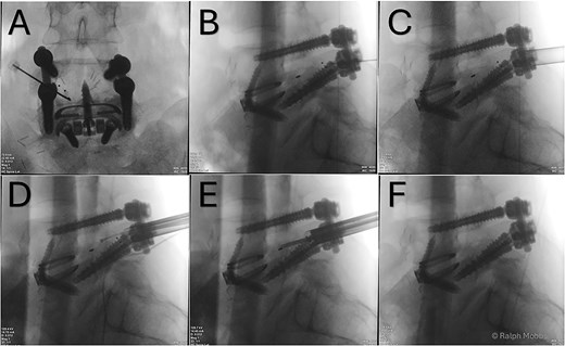 (A) AP X-ray. Initial needle localization over the TLIF cage. (B) Lateral X-ray with needle positioned on posterior aspect of TLIF cage. (C) Working channel positioned immediately posterior to cage. (D) RF diathermy to dissect around cage (see Video 1). (E) Dissection around cage using multiple instruments. (F) Post removal of cage, with no TLIF device evident.