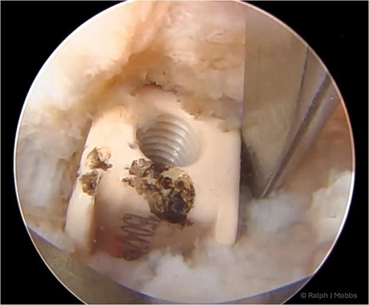 Endoscopic view of the TLIF cage in scar with dissection around the device prior to removal of the migrated TLIF cage.