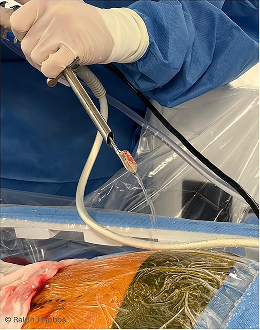 Immediate post removal with the endoscope, working channel, grasping tool (endoscopic ligament cutter), and TLIF cage removed as one (see Video 1 for maneuver).