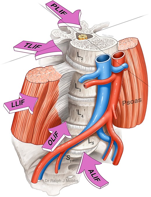Lumbar interbody fusion (LIF) techniques (with permission of Mobbs et al., JSS).