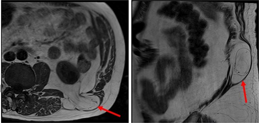 The patient’s MR imaging, which clearly shows the superior lumbar hernia. Axial section (left), sagittal section (right).