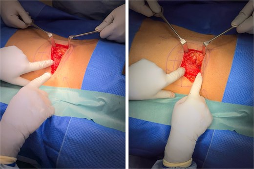 Intraoperative pictures of the superior lumbar hernia.