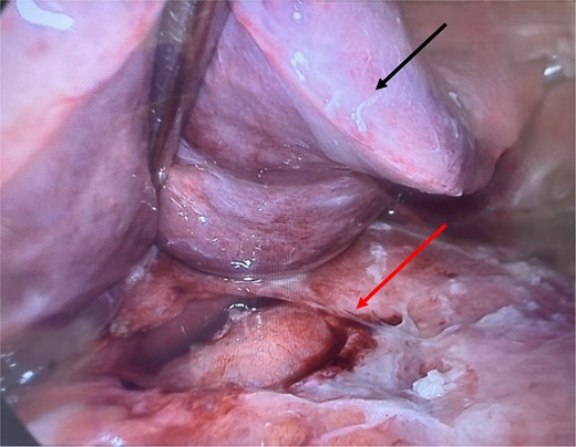 Intraoperative image with liver (black/upper arrow) retracted superiorly, with large tumor (red/lower arrow) surrounding the lesser curvature, anterior antrum of the stomach, and porta hepatis, accompanied by fibrin deposits.