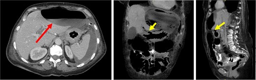 CT images demonstrated a large, thin-walled anterior epigastric collection with an air-fluid level (long/red arrow) measuring 10.8 × 5.8 × 16.4 cm, positioned anterior to the left hepatic lobe and the gastric body. This collection appeared to communicate with the suspected perforation site (short/yellow arrows). Additionally, loculated fluid pockets were observed around the spleen and the left upper quadrant bowel loops, along with interspersed free fluid and gas locules likely leaking from the stomach.