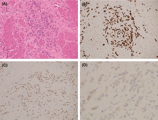 (A) Medium power: atypical cells with a small amount of cytoplasm and hyperchromatic nuclei with vesicular chromatin and small nucleoli. (B) GATA 3 immunohistochemistry: strong positive nuclear staining, which in the context of CK7 positivity and CK20 negativity is in keeping with metastatic carcinoma of breast origin—supported by positive estrogen receptor staining. (C) Estrogen receptor IHC: 2+ staining. PR and HER2 were negative. (D) E-cadherin IHC: weak patchy staining is negative and is in keeping with lobular differentiation—explains the poorly cohesive nature of the tumor cells, which infiltrate as single cells and single files, and cords rather than well-developed nests and ductal formations.