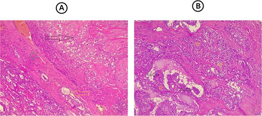 (A) Section from the thyroid tumor showing an area composed of dyscohesive plasmacytoid cells with salt-pepper chromatin and presence of eosinophilic material in between them representing amyloid material (dark arrow), while bellow it, separated by a fibrous band (green star), there is an area showing follicular epithelial cells, with nuclear features of papillary thyroid carcinoma (yellow arrow). Hematoxylin and eosin stain, 4 × 10. (B) Section from the lymph node reveal both tumor components mixed with each other, area showing papillary structures that covered by follicular epithelial cells with nuclear features of papillary thyroid carcinoma (dark arrows) with other area composed of solid nests of dyscohesive cells that representing the medullary thyroid carcinoma. Hematoxylin and eosin stain, 4 × 10.