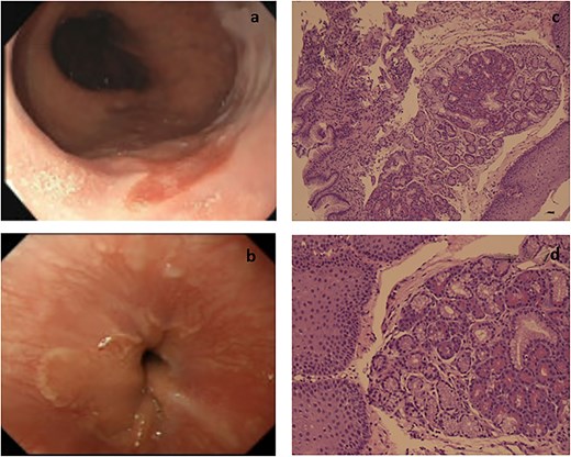 Endoscopic and pathological images. (a) GEJ showing irregular salmon colored patch. (b) Distal esophagus exhibiting a patch with irregular borders. (c) Section shows pancreatic lobules with esophageal squamous mucosa and gastric type mucosa of the GEJ (10×). (d) Higher power showing the squamous mucosa of GEJ with underlying pancreatic tissue (40×).