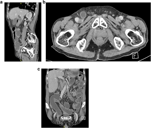 (a–c) Direct inguinal hernia.
