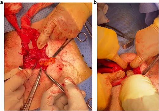 (a) Amyand’s direct inguinal hernia containing a non-inflamed appendix. (b) Femoral hernia.
