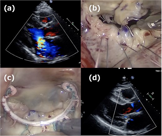 First operation images. (a) Severe mitral regurgitation caused by A2 prolapse. (b) Intraoperative image showing the placement of four 22-mm ePTFE loops fixed to the A2 segment with 5/0 polypropylene sutures. (c) The 36-mm CG-future band (Medtronics) was applied for mitral annuloplasty. (d) One week postoperative echocardiogram showing no residual mitral regurgitation.