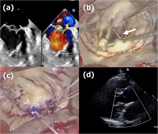 Second operation images. (a) Moderate mitral regurgitation caused by partial prolapse of the A2 segment, observed 3 weeks after the initial operation. (b) Intraoperative image showing the rupture of the ePTFE loop at the fixation site onto the leaflet during reoperation. (c) Three 20-mm long CV4 loops were attached to the posterior papillary muscle, and those loops were fixed to the A2 segment with CV4. (d) One week postoperative echocardiogram showing no residual mitral regurgitation after reoperation.