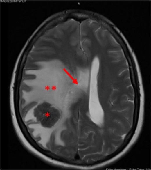 Brain MRI T2 weighted image, showing right parietal lobe lesion (asterisk), surrounded by edema (**) and causing right lateral ventricular compression with midline shift (arrow).