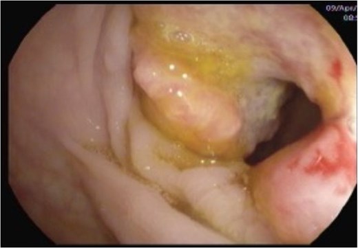Circumferential, non-obstructing, irregular growth in the sigmoid colon around 35 cm from the anal verge.